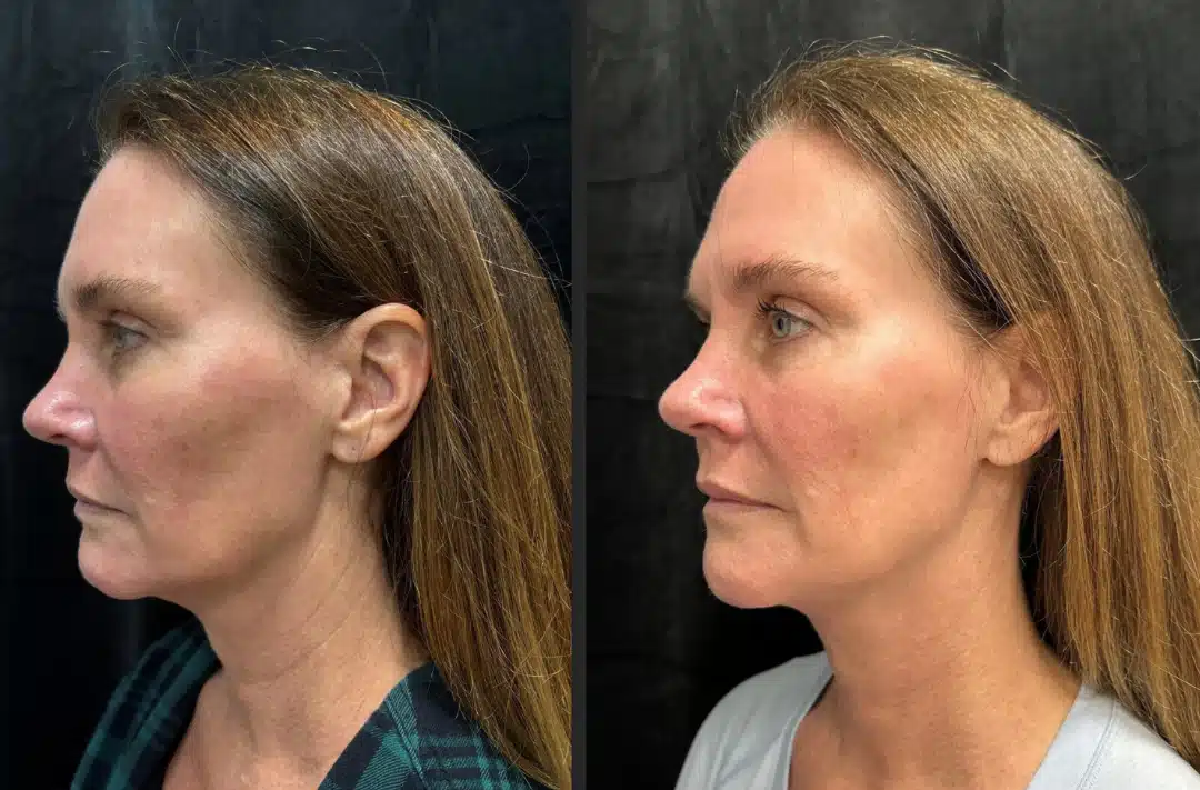 MyEllevate before and after, case 253282, view 1 of 2: before on the left, after on the right