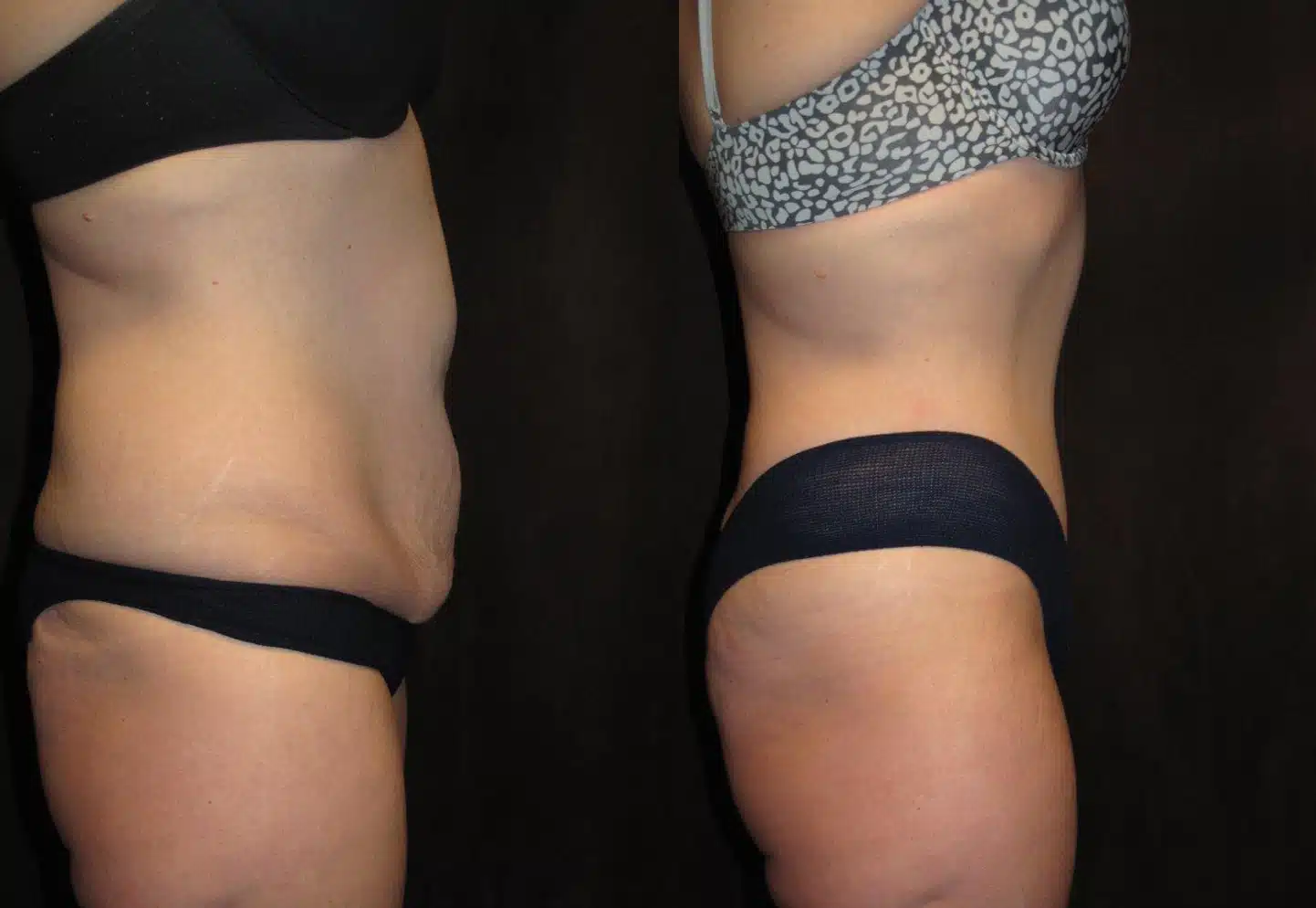Tummy Tuck before and after, case 253107, view 1 of 2: before on the left, after on the right