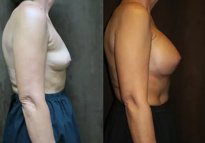 Breast Augmentation before and after, case 253185, view 2 of 2: before on the left, after on the right