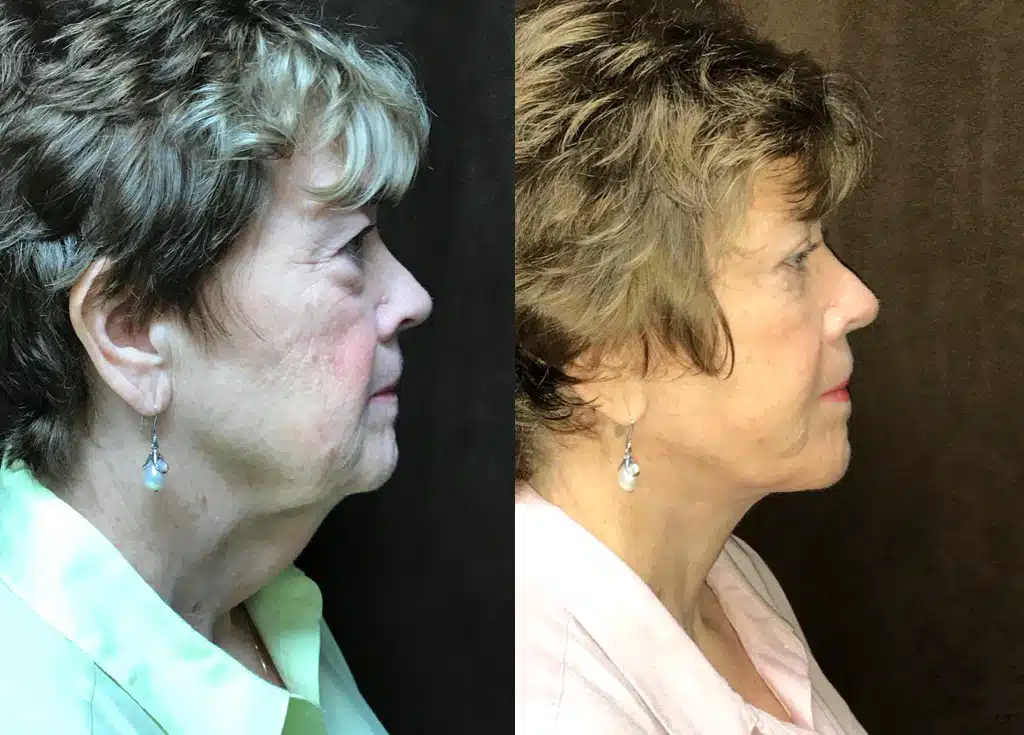 Facelift before and after, case 253268, view 2 of 2: before on the left, after on the right