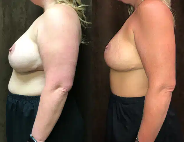 Mommy Makeover before and after, case 253072, view 2 of 2: before on the left, after on the right