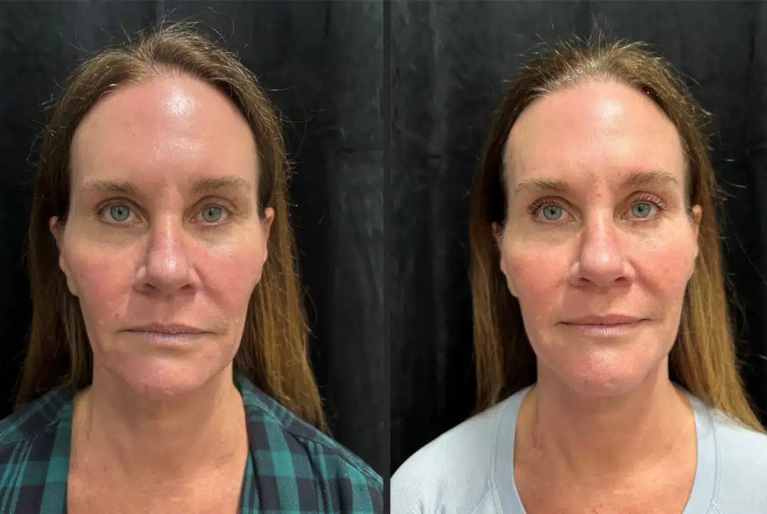 MyEllevate before and after, case 253282, view 2 of 2: before on the left, after on the right