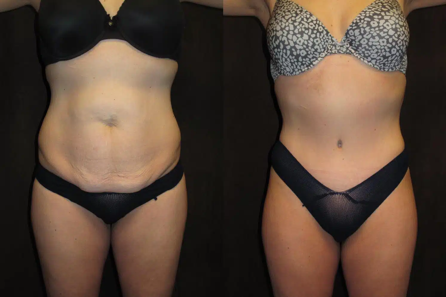 Tummy Tuck before and after, case 253107, view 2 of 2: before on the left, after on the right