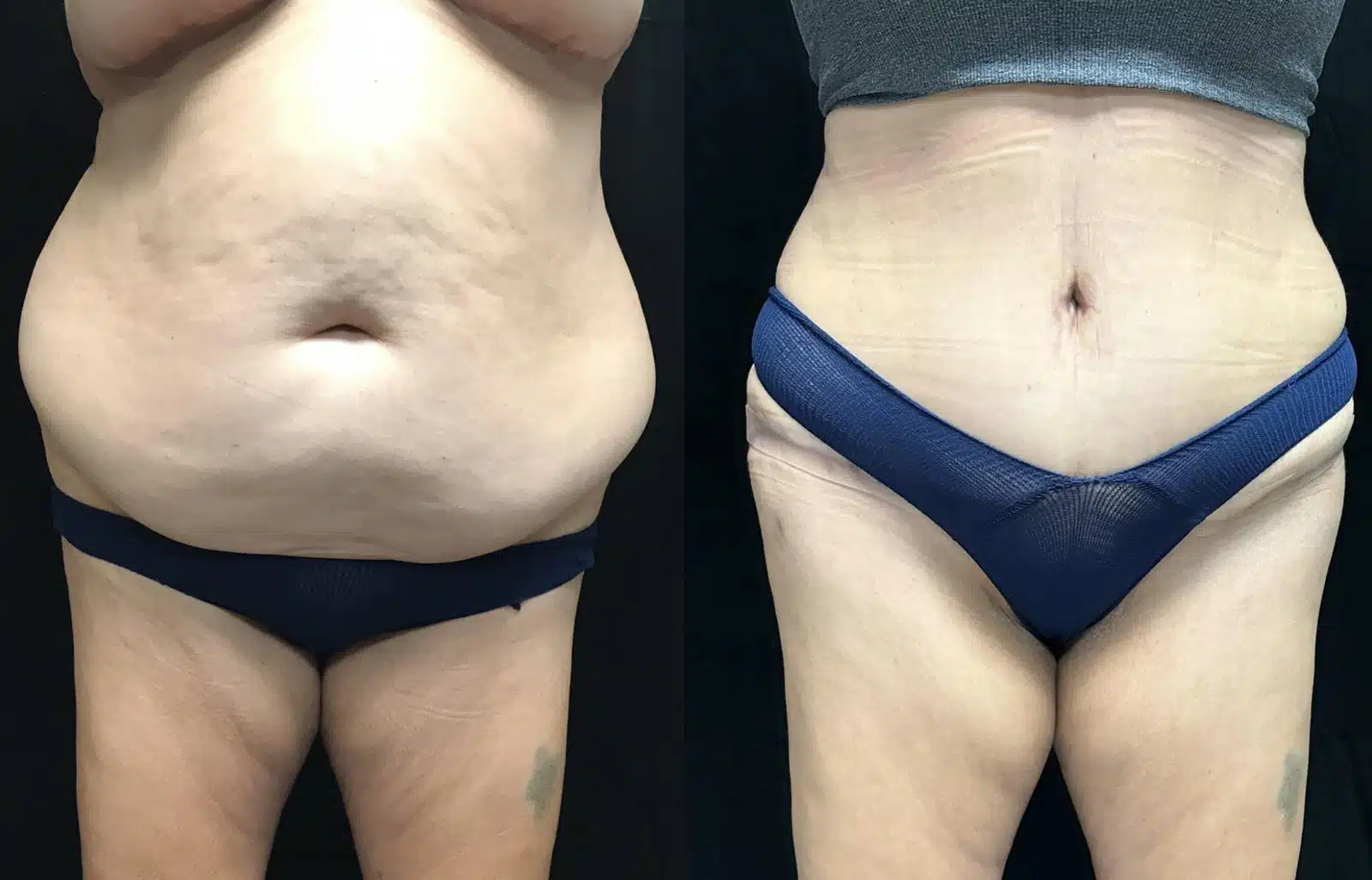 Tummy Tuck before and after, case 253166, view 1 of 2: before on the left, after on the right