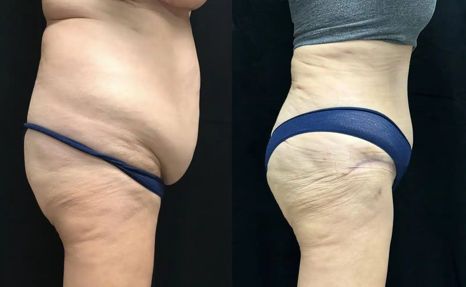 Tummy Tuck before and after, case 253166, view 2 of 2: before on the left, after on the right
