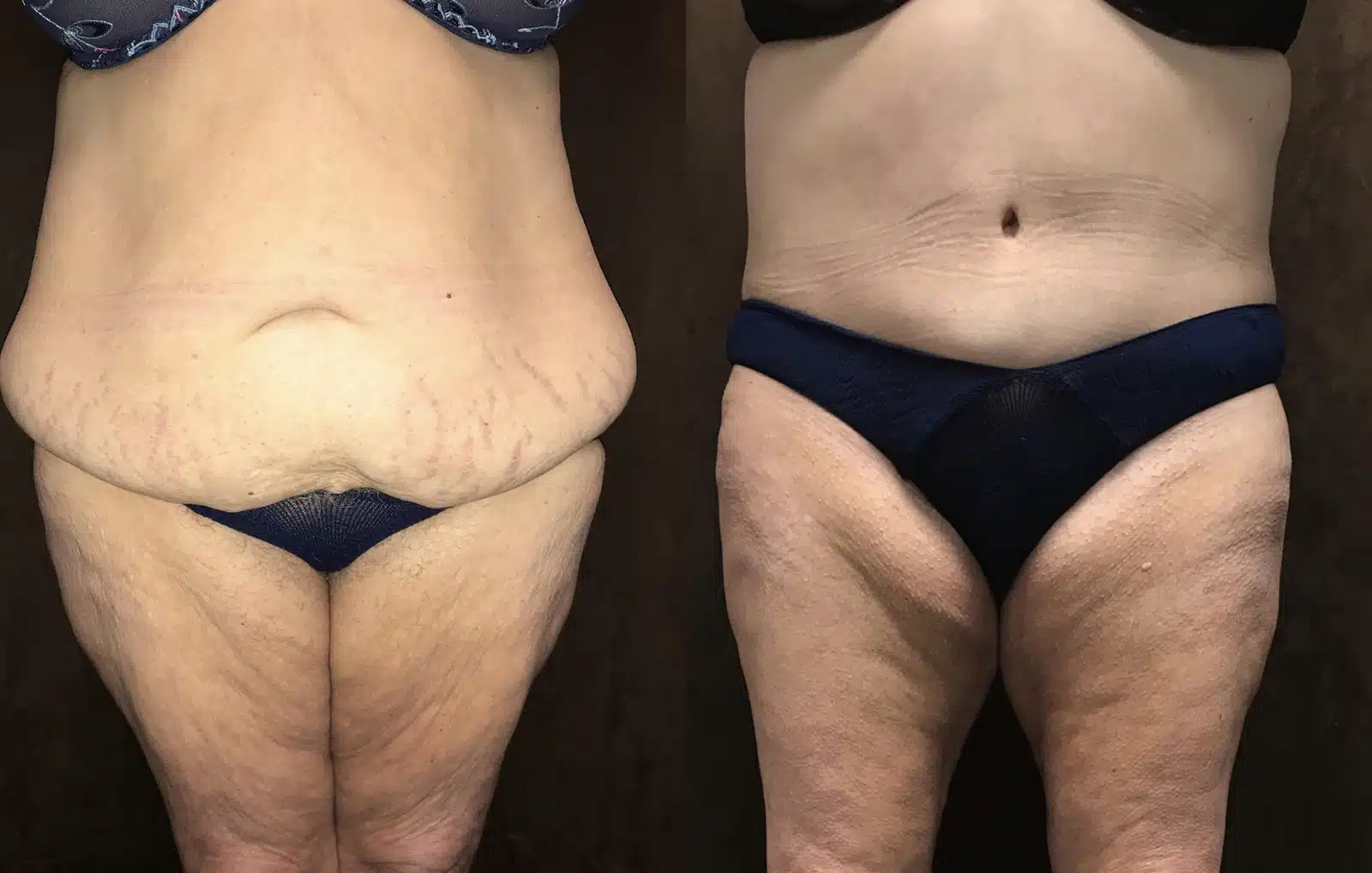 Tummy Tuck before and after, case 253167: before on the left, after on the right