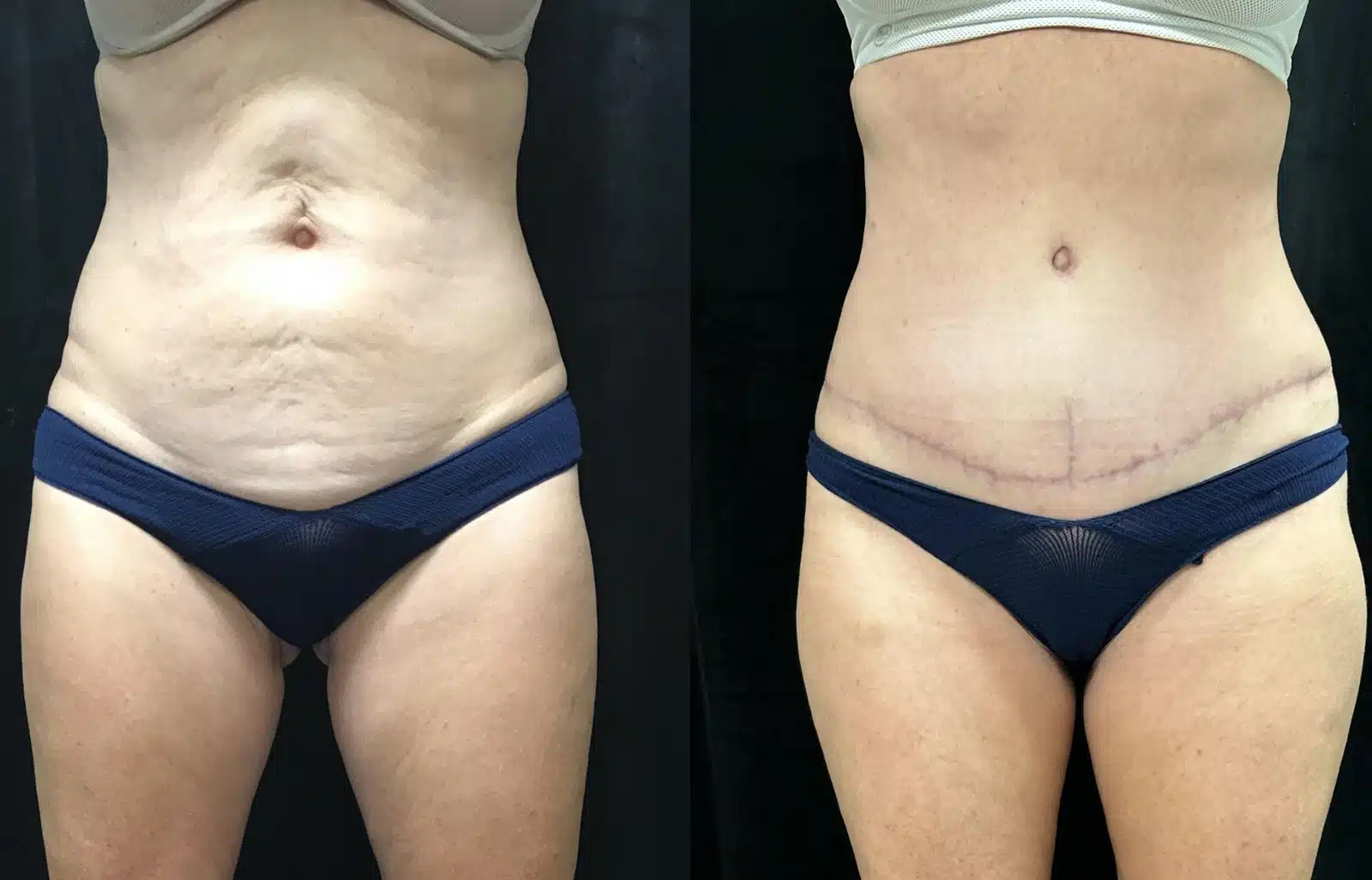 Tummy Tuck before and after, case 253168: before on the left, after on the right