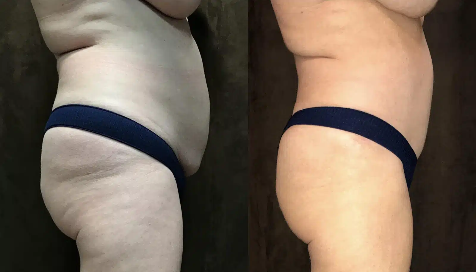 Tummy Tuck before and after, case 253169, view 1 of 2: before on the left, after on the right