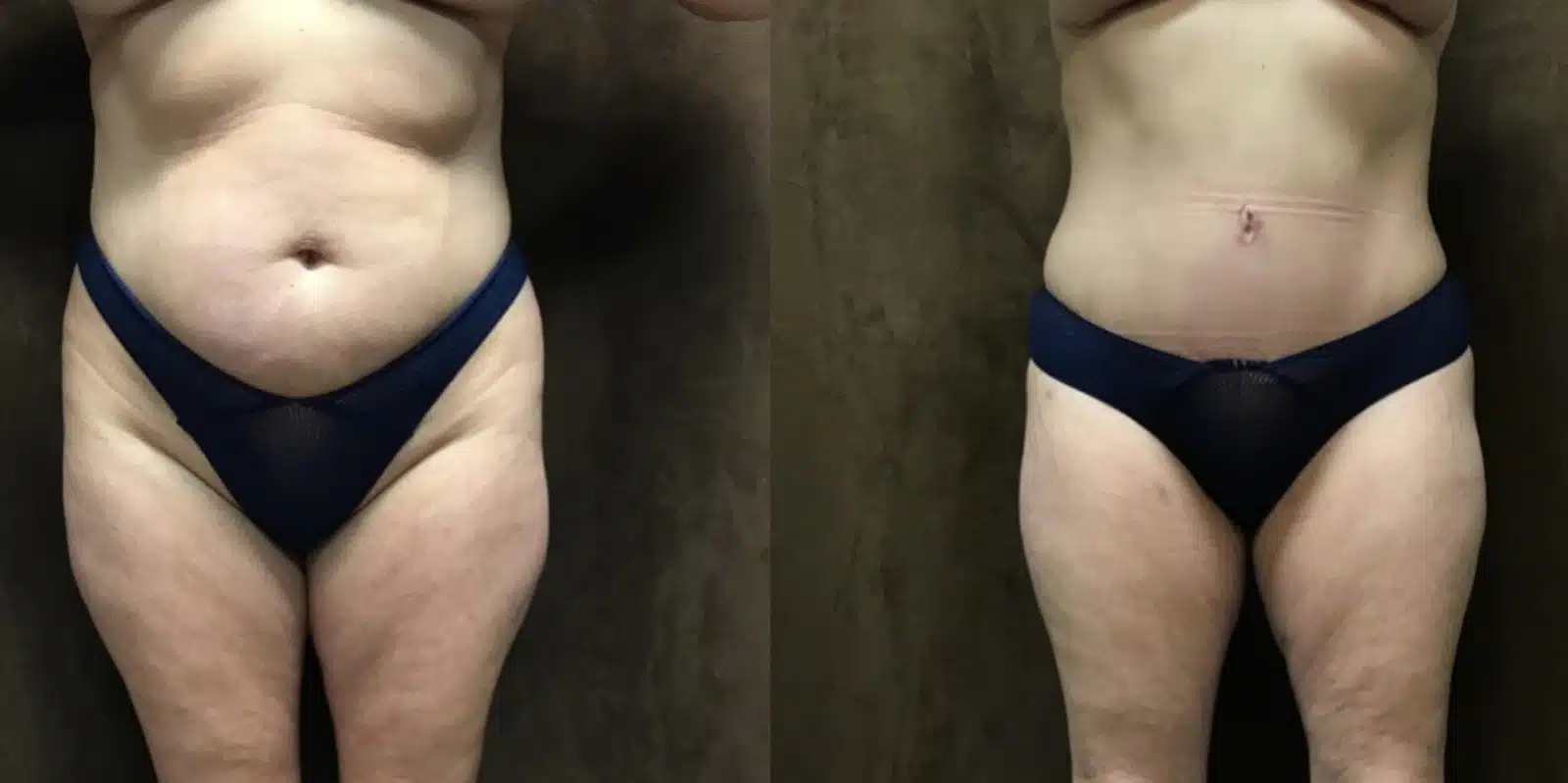 Tummy Tuck before and after, case 253169, view 2 of 2: before on the left, after on the right
