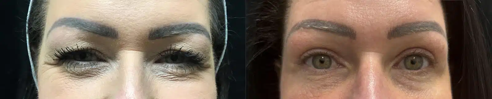 Eyelid Surgery before and after, case 253263: before on the left, after on the right