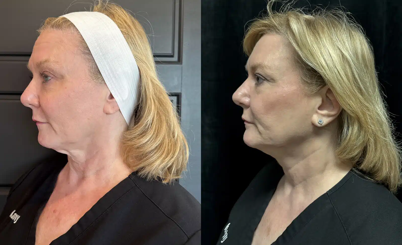 MyEllevate before and after, case 253283: before on the left, after on the right