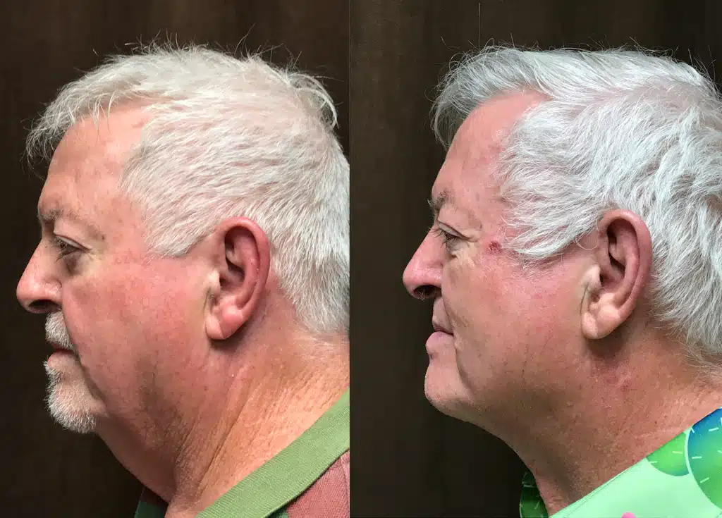 Neck Lift before and after, case 253291: before on the left, after on the right