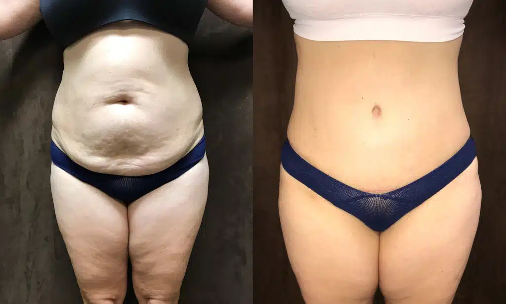 Tummy Tuck before and after, case 253108, view 1 of 2: before on the left, after on the right