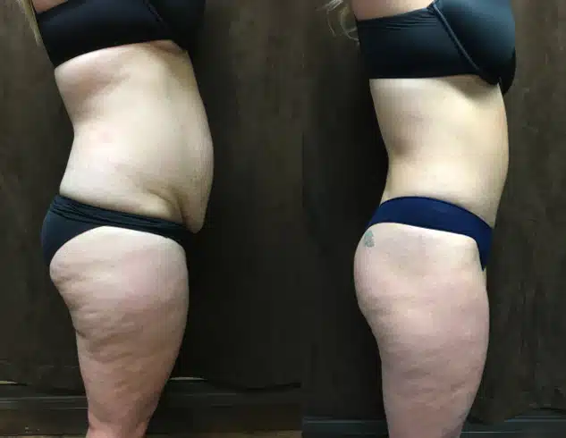 Mommy Makeover before and after, case 253073, view 3 of 3: before on the left, after on the right