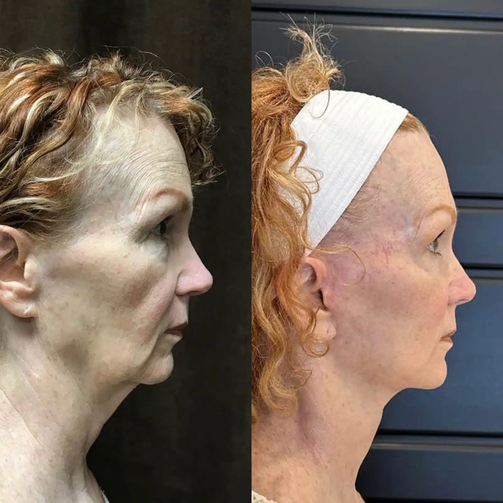 Facelift before and after, case 253270, view 1 of 2: before on the left, after on the right