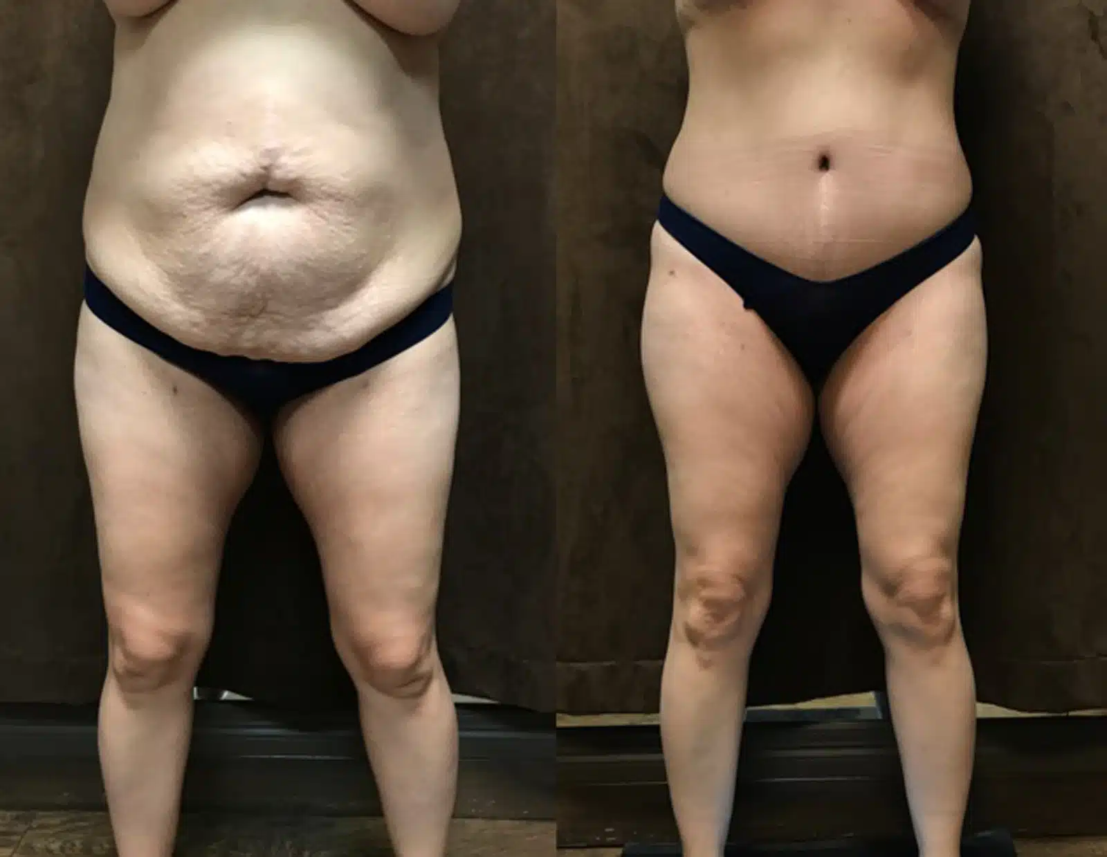 Mommy Makeover before and after, case 253074, view 1 of 2: before on the left, after on the right