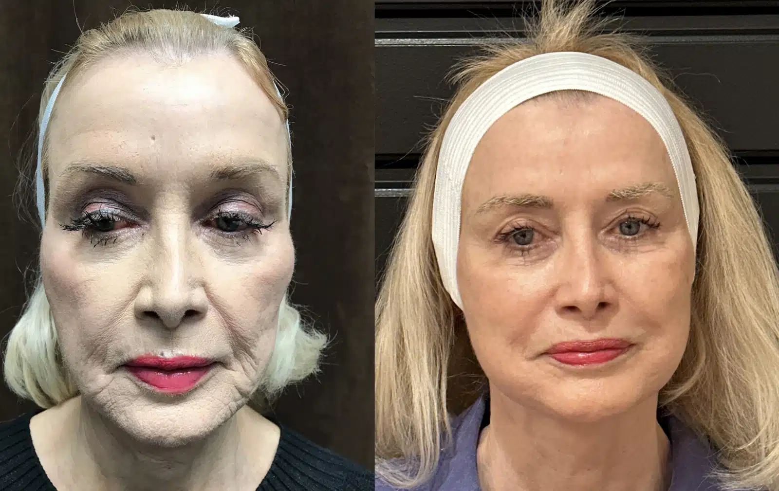 Neck Lift before and after, case 253292: before on the left, after on the right