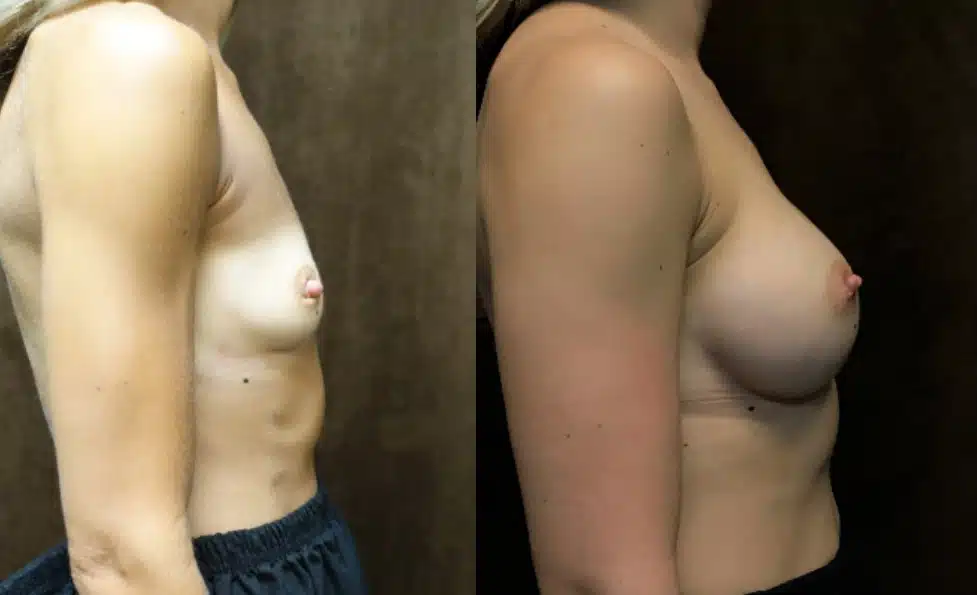 Breast Augmentation before and after, case 253187, view 2 of 2: before on the left, after on the right