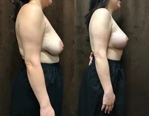 Breast Lift (Mastopexy) before and after, case 253230, view 2 of 2: before on the left, after on the right