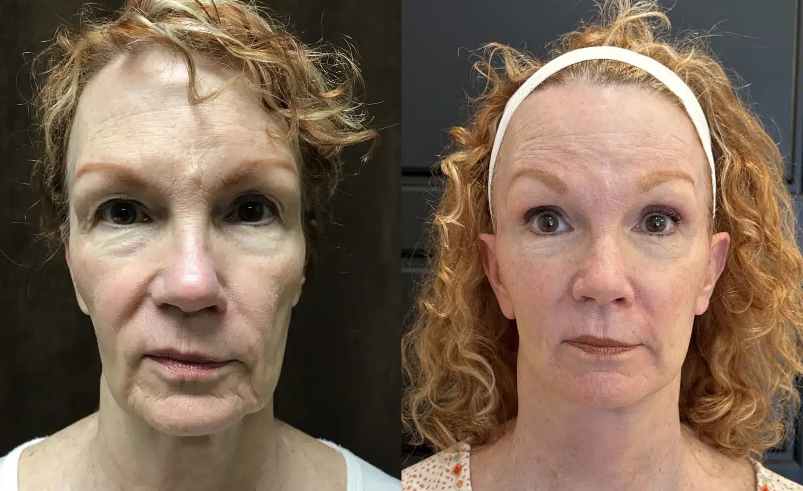 Facelift before and after, case 253270, view 2 of 2: before on the left, after on the right