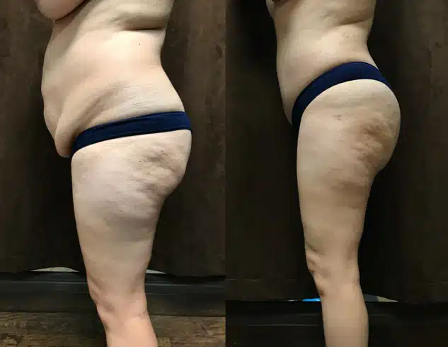 Mommy Makeover before and after, case 253074, view 2 of 2: before on the left, after on the right
