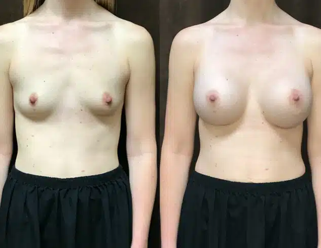 Breast Augmentation before and after, case 253188, view 1 of 2: before on the left, after on the right