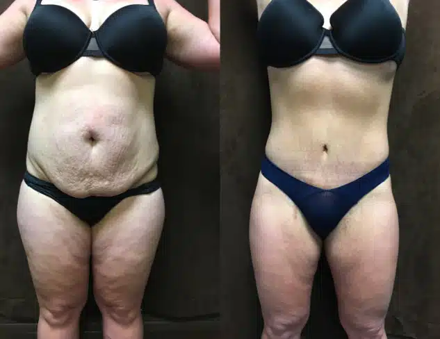 Tummy Tuck before and after, case 253110, view 1 of 3: before on the left, after on the right