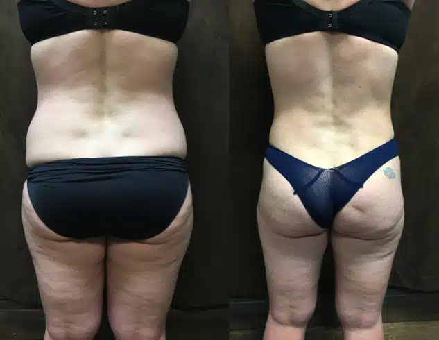 Tummy Tuck before and after, case 253110, view 2 of 3: before on the left, after on the right