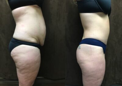 Mommy Makeover before and after photo