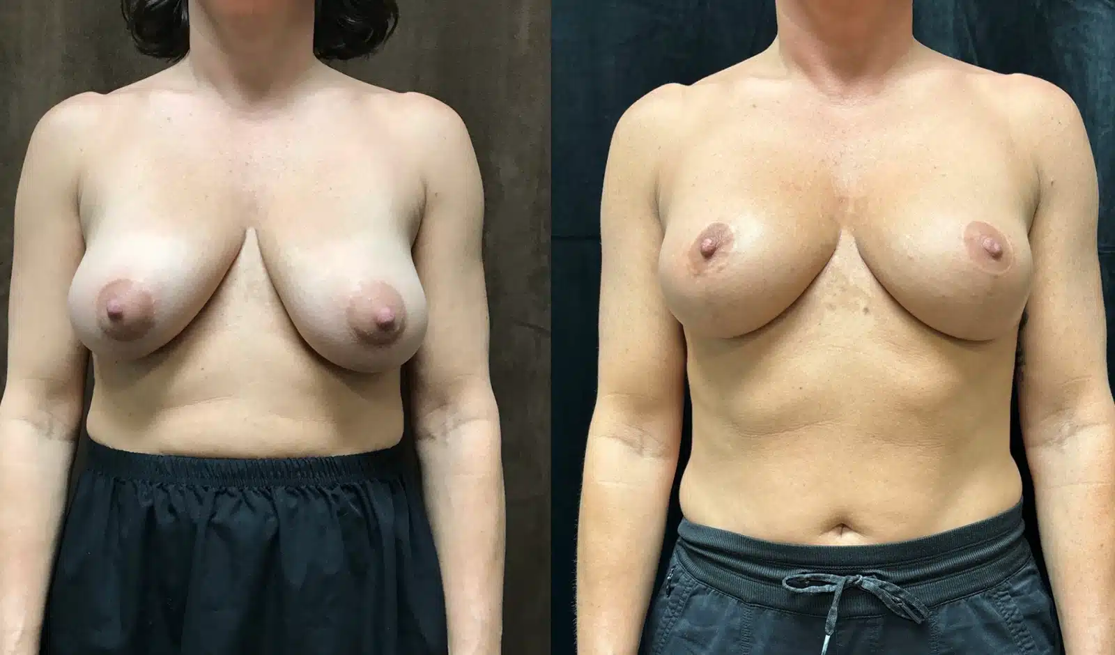 Breast Lift (Mastopexy) before and after, case 253232, view 1 of 2: before on the left, after on the right