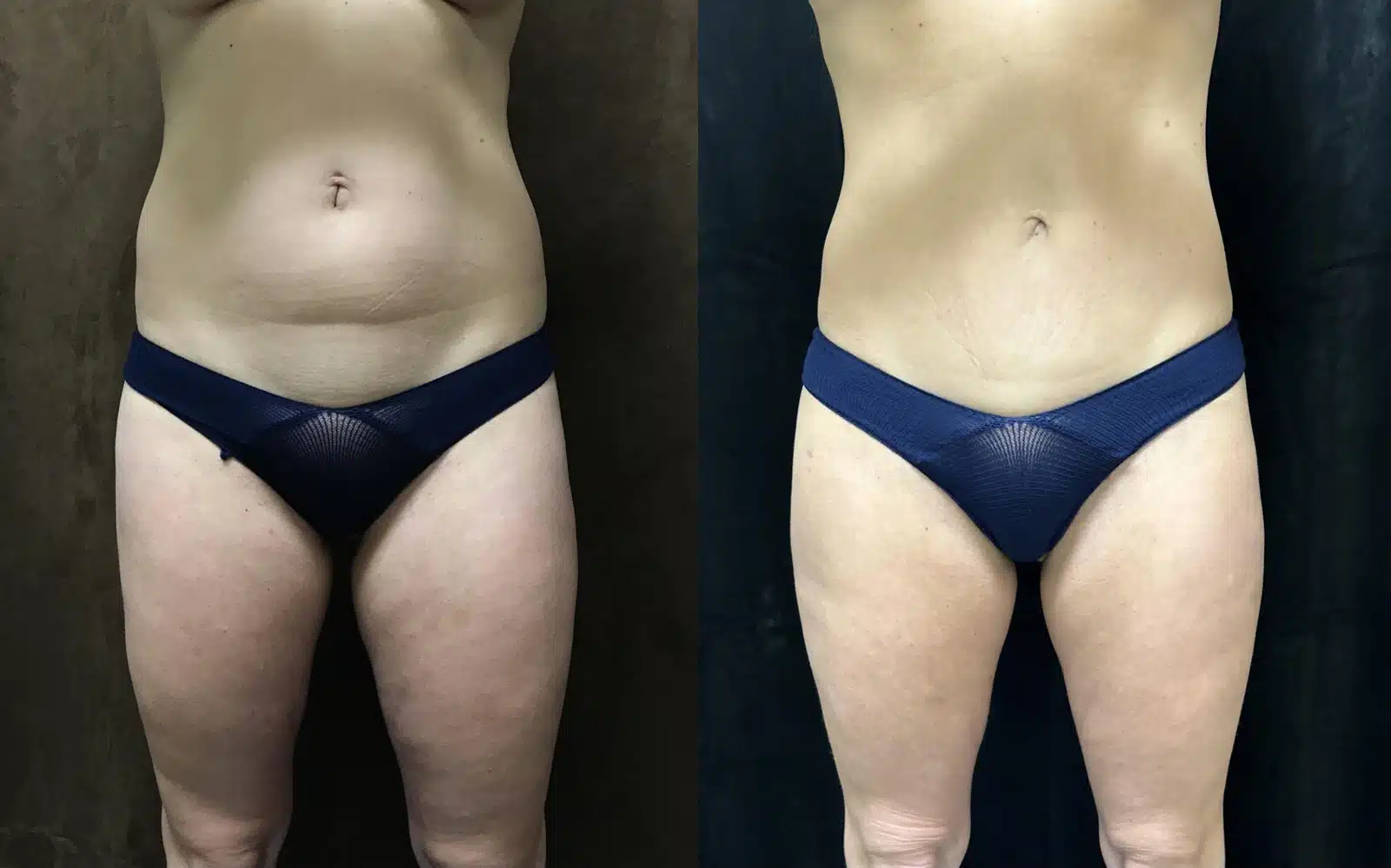 Mommy Makeover before and after, case 253076, view 1 of 2: before on the left, after on the right