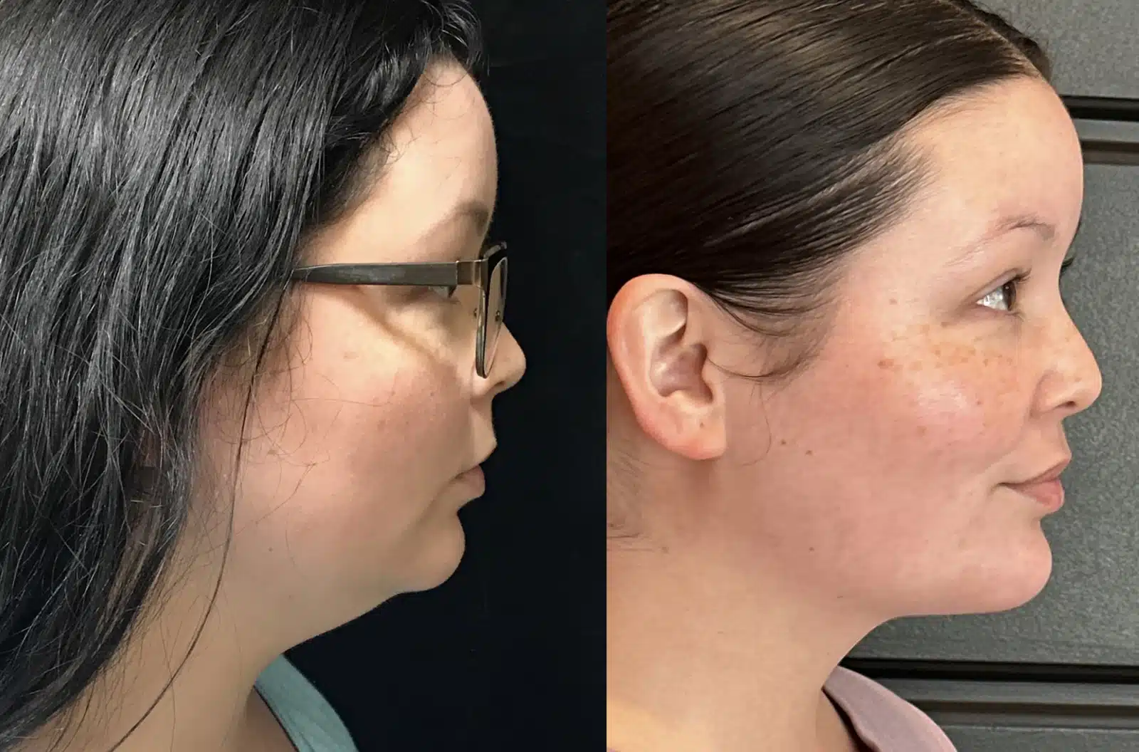Neck Lift before and after, case 253294, view 1 of 2: before on the left, after on the right
