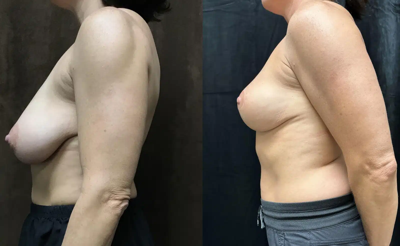 Breast Lift (Mastopexy) before and after, case 253232, view 2 of 2: before on the left, after on the right