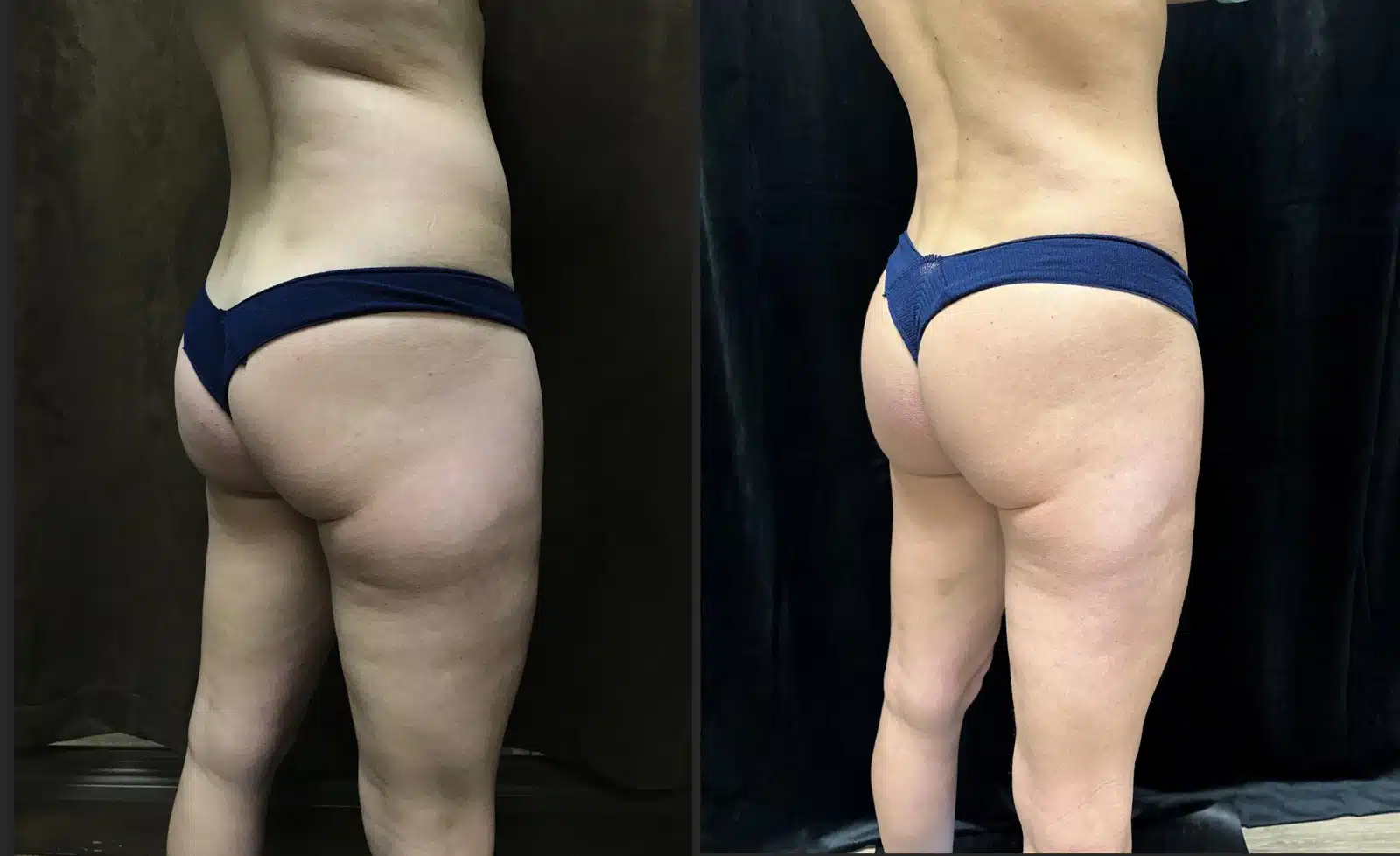 Mommy Makeover before and after, case 253076, view 2 of 2: before on the left, after on the right
