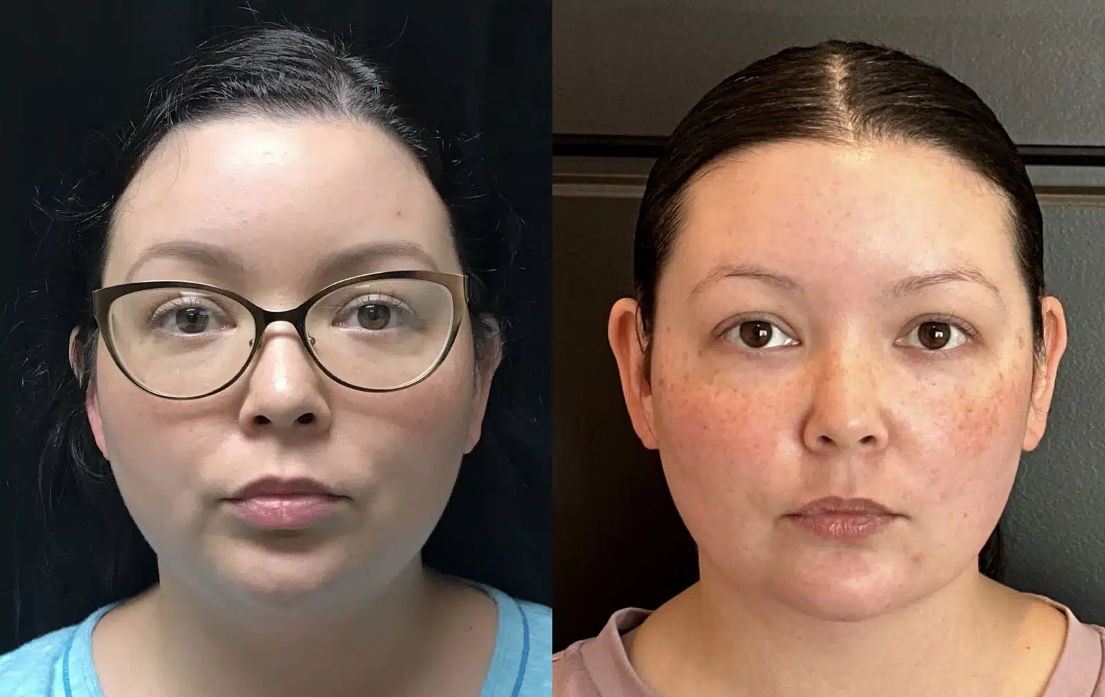 Neck Lift before and after, case 253294, view 2 of 2: before on the left, after on the right