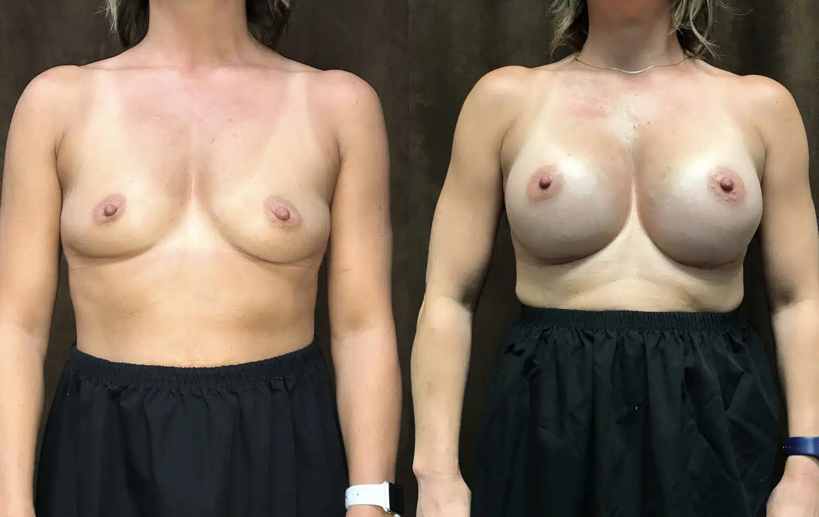 Breast Augmentation before and after, case 253201: before on the left, after on the right