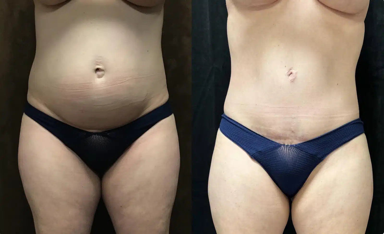 Mommy Makeover before and after, case 253077, view 1 of 2: before on the left, after on the right
