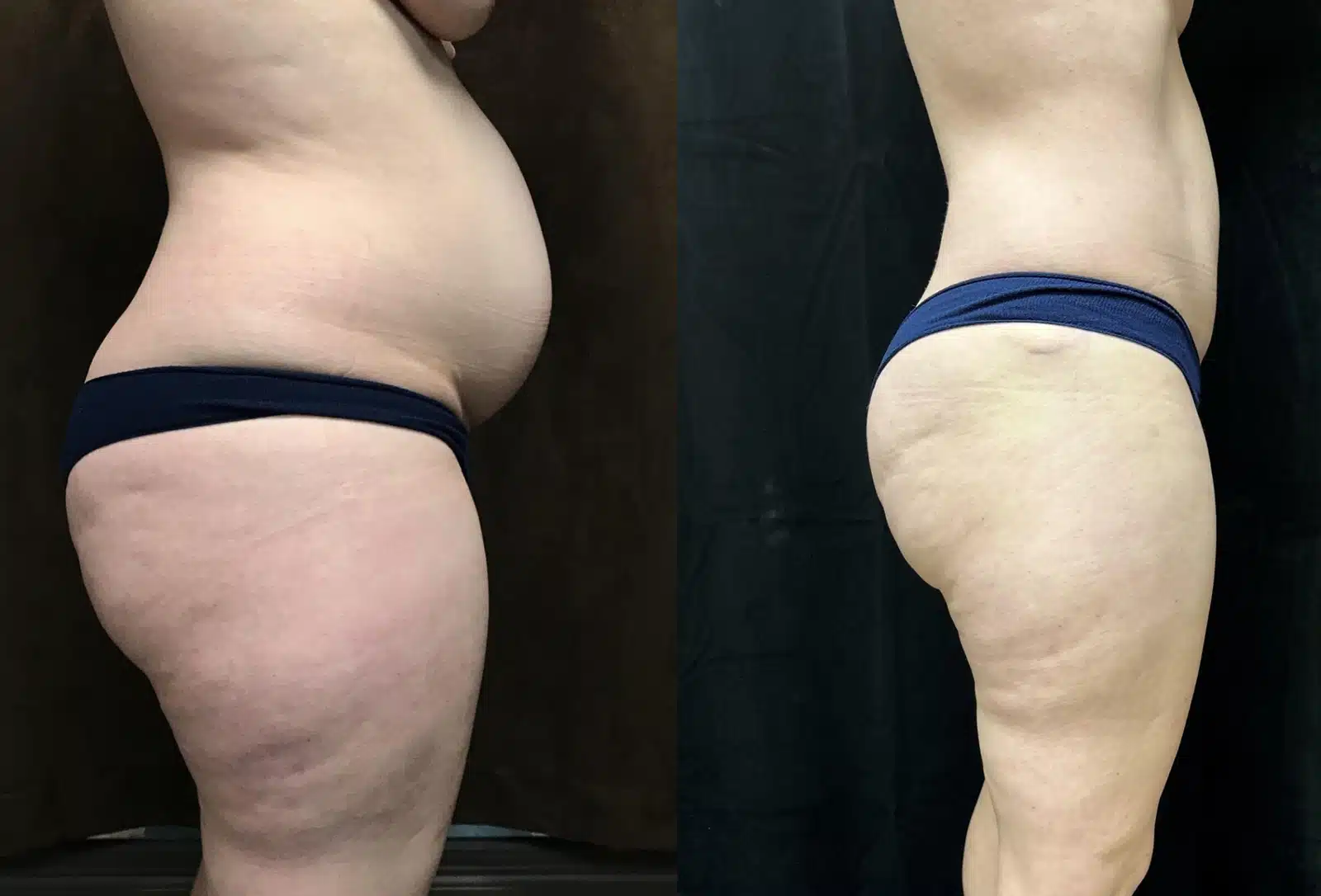 Mommy Makeover before and after, case 253077, view 2 of 2: before on the left, after on the right