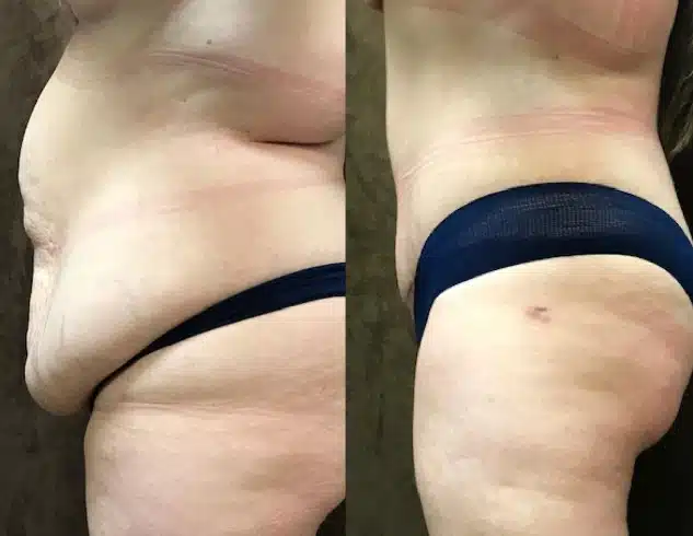 Tummy Tuck before and after, case 253112, view 2 of 3: before on the left, after on the right