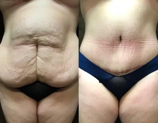 Tummy Tuck before and after, case 253112, view 3 of 3: before on the left, after on the right