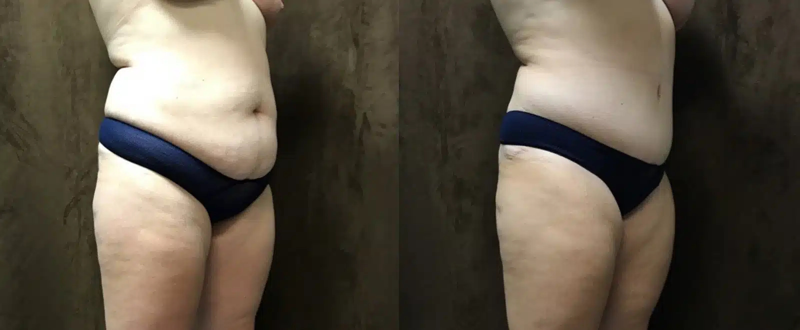 Tummy Tuck before and after, case 253113: before on the left, after on the right