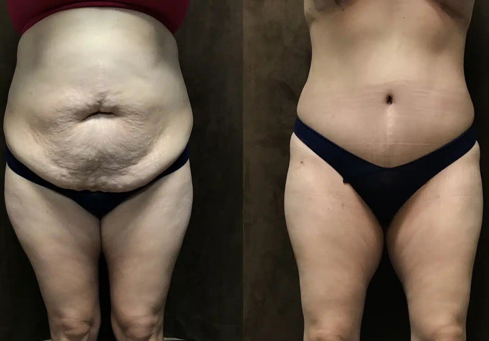 Tummy Tuck before and after, case 253114, view 1 of 2: before on the left, after on the right