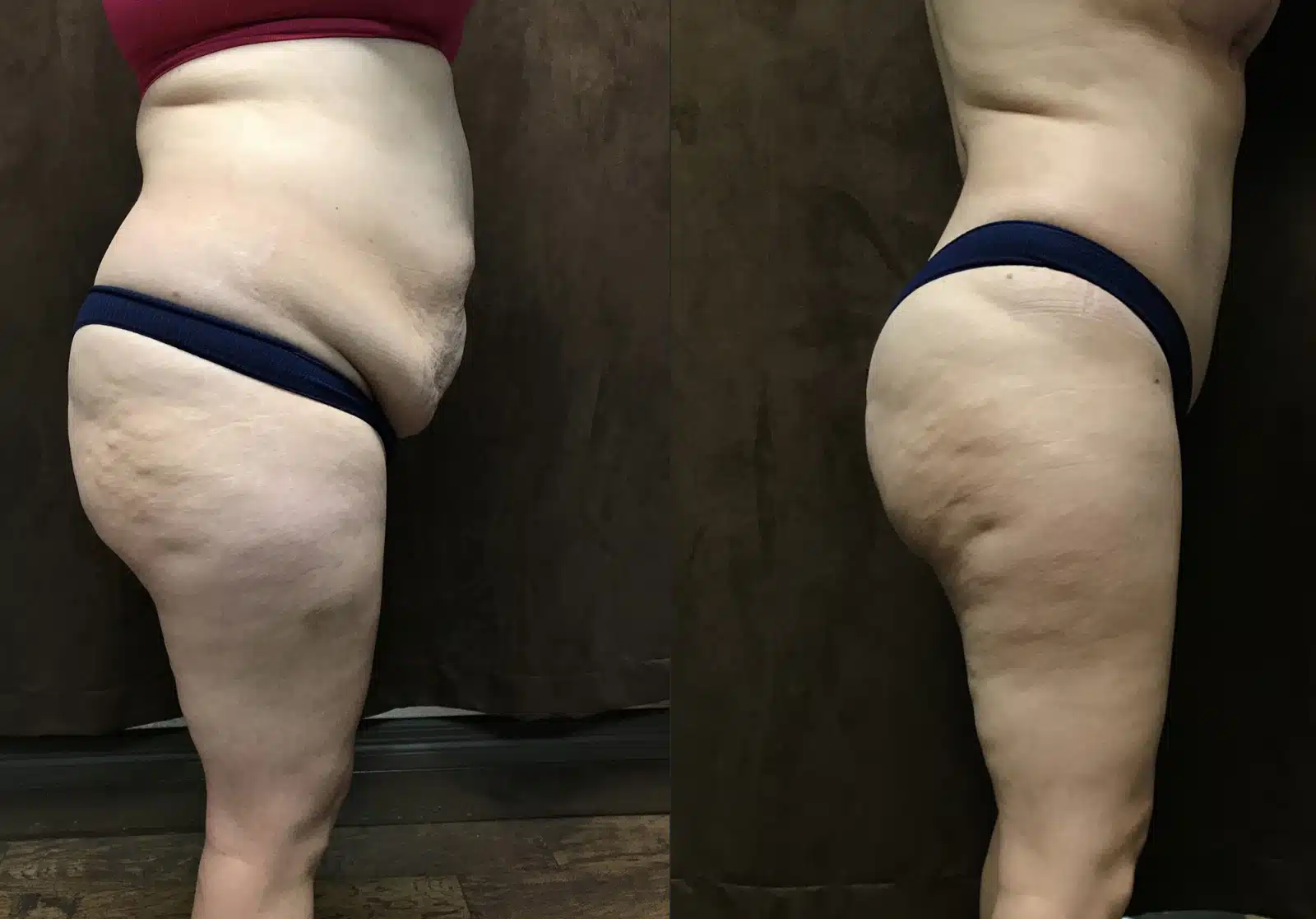 Tummy Tuck before and after, case 253114, view 2 of 2: before on the left, after on the right