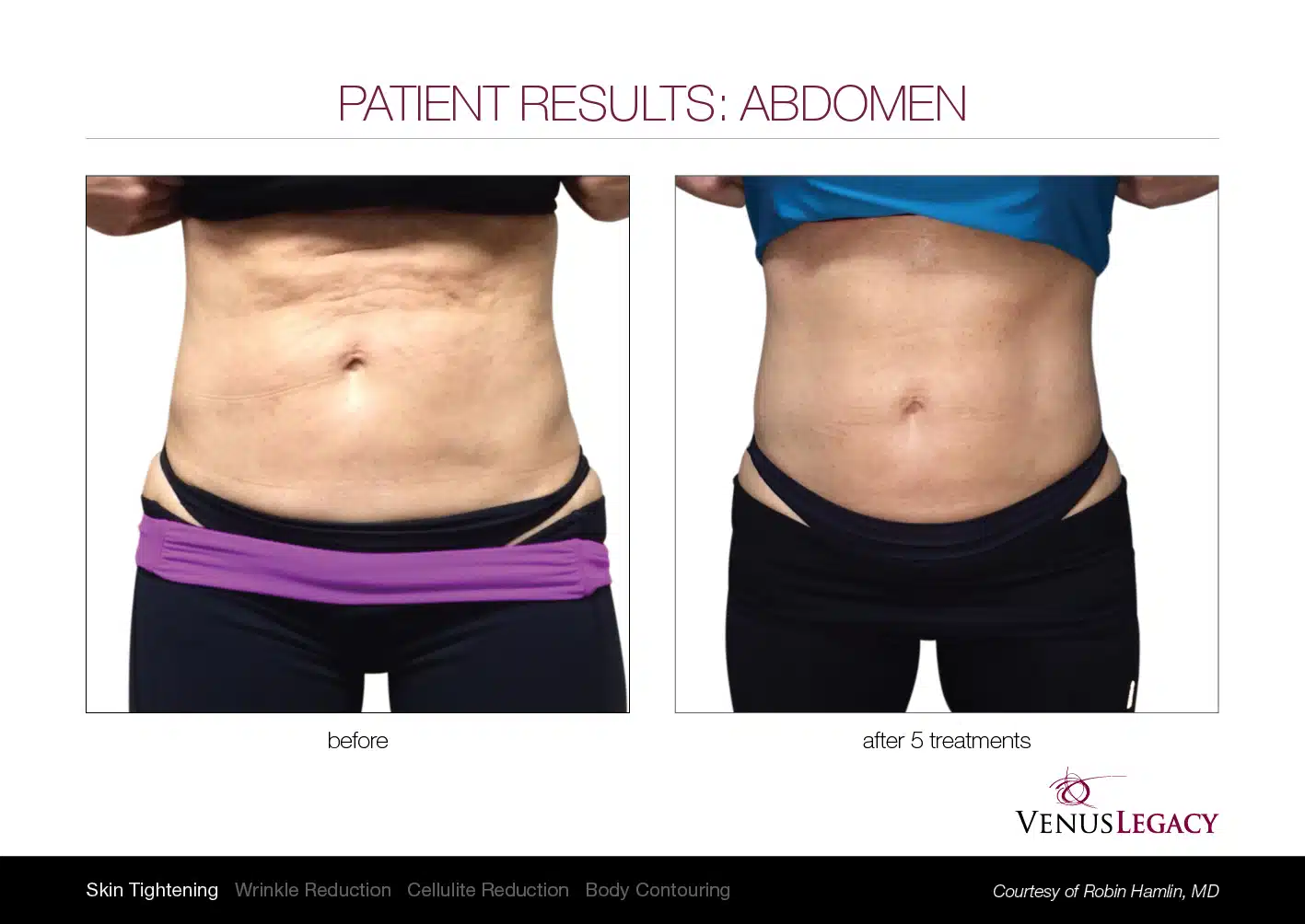 Abdomen contouring before and after results