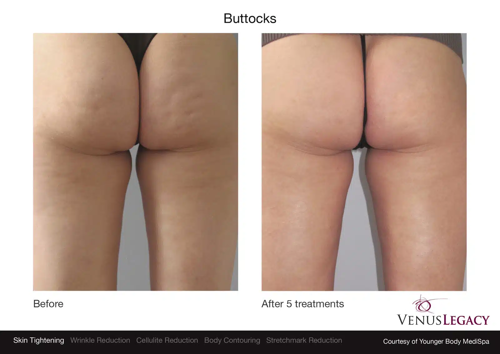 Buttocks contouring before and after results