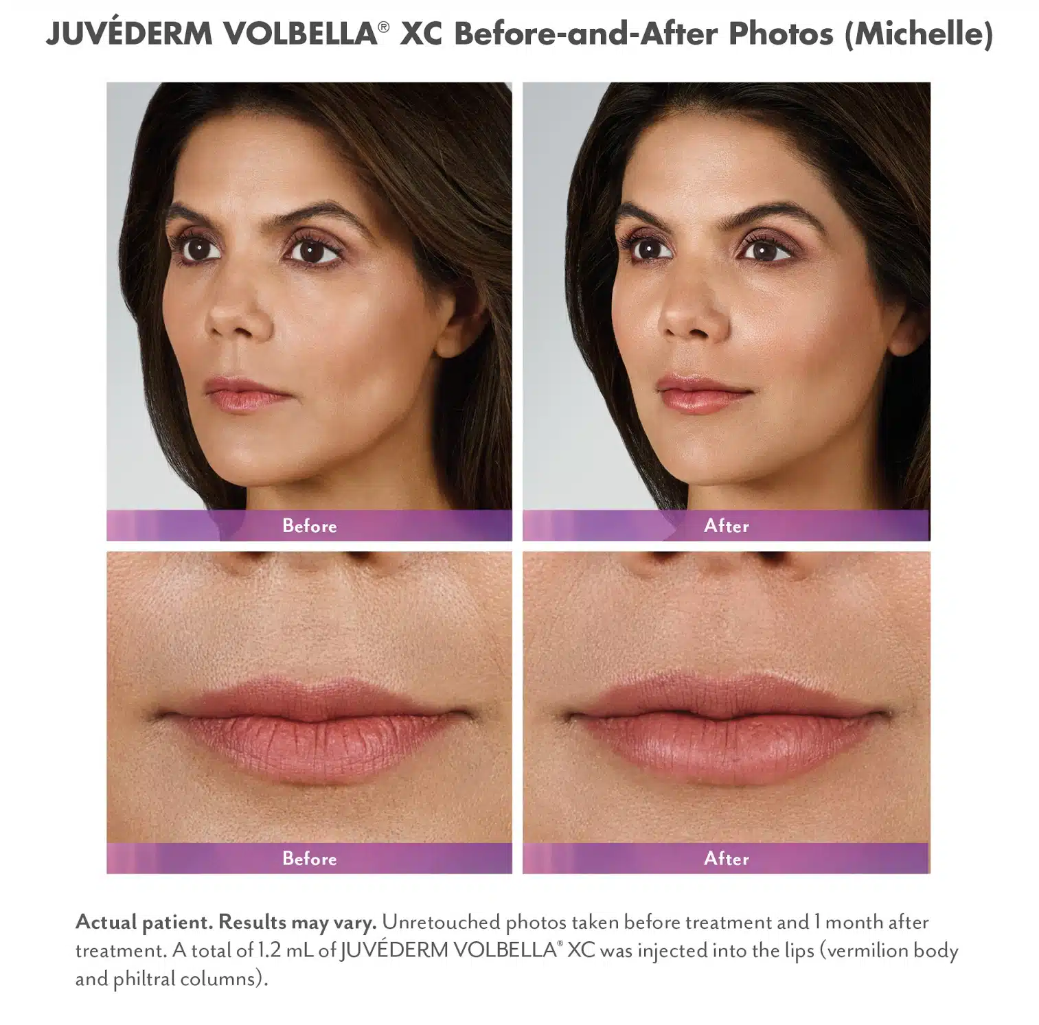 Juvederm Volbella XC before and after photos