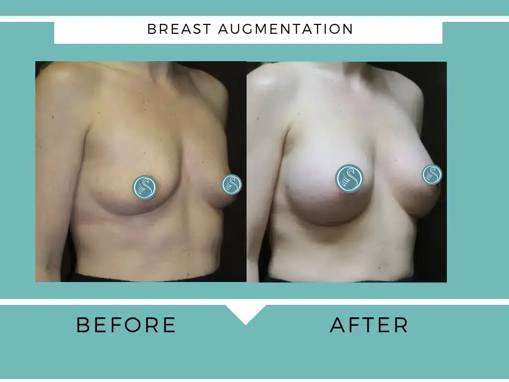 Breast augmentation before and after photo