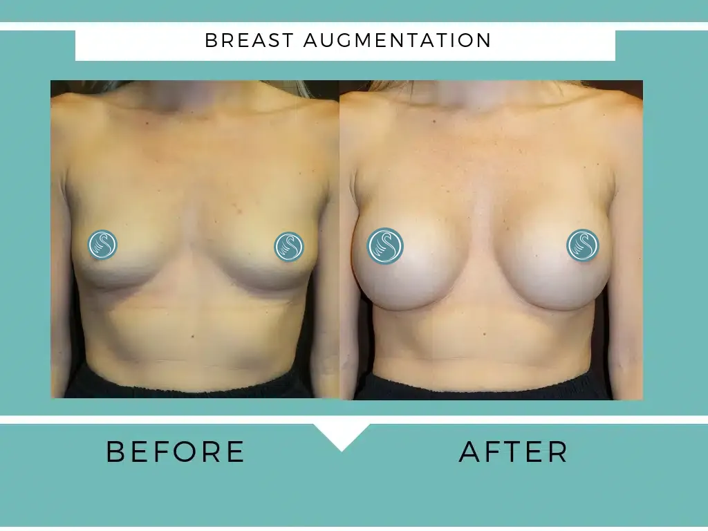 Breast augmentation before and after photo