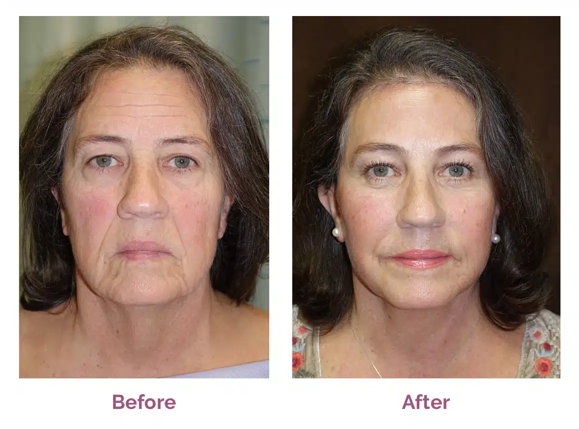 Facelift before and after photo by Fort Worth Plastic Surgery in Fort Worth, TX