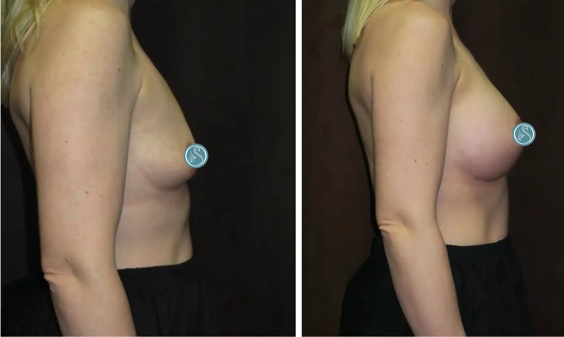 Patient 2: Before and After Breast Augmentation
